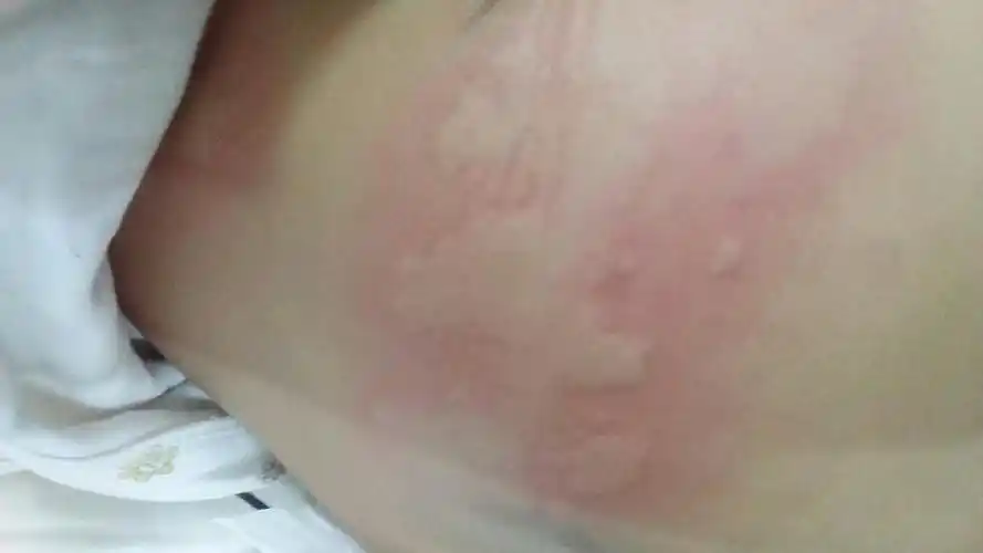 是荨麻疹吗_百度宝宝知道