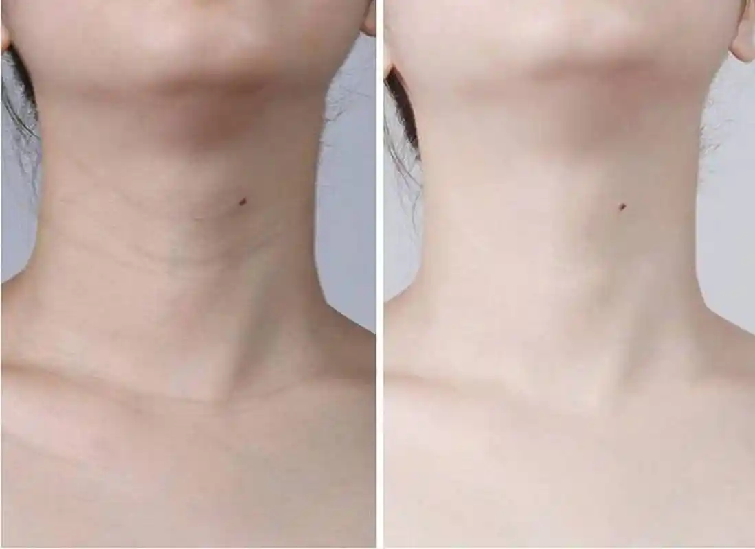 有的人对于皮秒激光,这种治疗方式比较适应,但是有的患者产生的颈纹