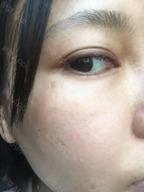 【激光祛斑】以色列飞顿*进口辉煌360*全脸祛斑/雀斑/黄褐斑/晒斑/老