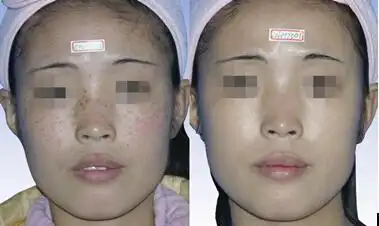 美国际整形医院独家引进南京首台祛斑神器——飞顿大q,直击色斑复源