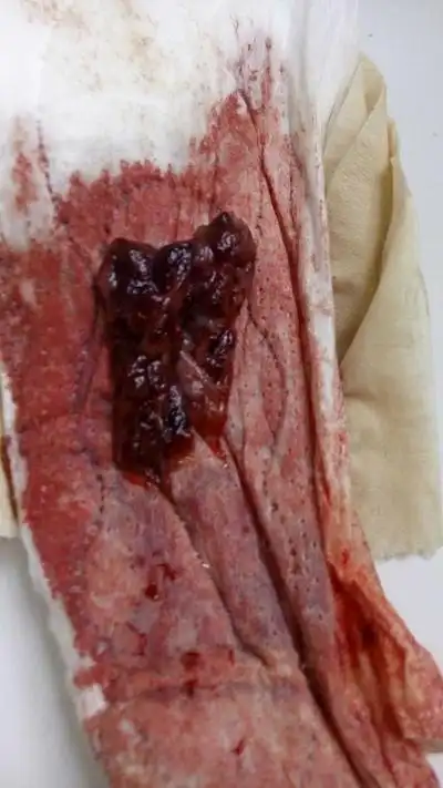 流产掉下来的孕囊图片 (50)