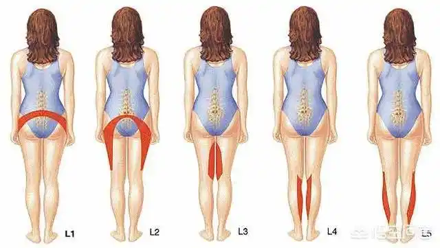 腰椎间盘4和5突出屁股臀疼是怎么回事